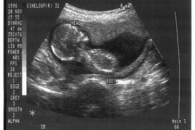 Early Medical Abortion Increased 154% in Past Decade, CDC Report Finds