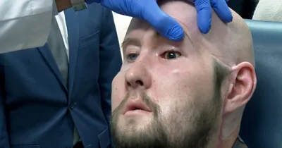 Surgeons perform world’s first eye transplant
